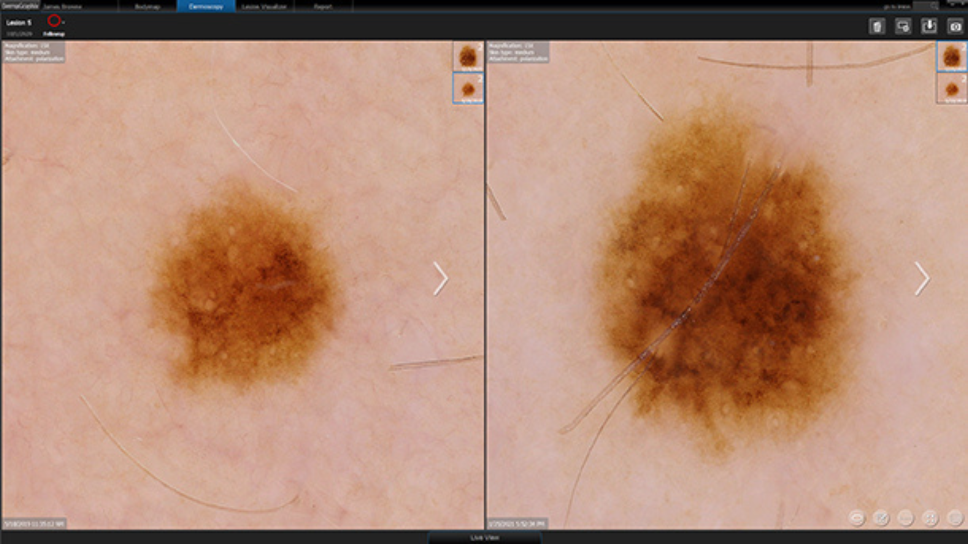 Skin cancer
