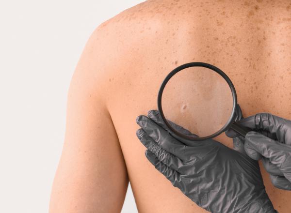 Skintel Optical Biopsy Close