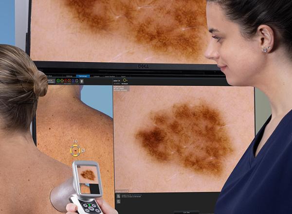 Skintel Optical Biopsy